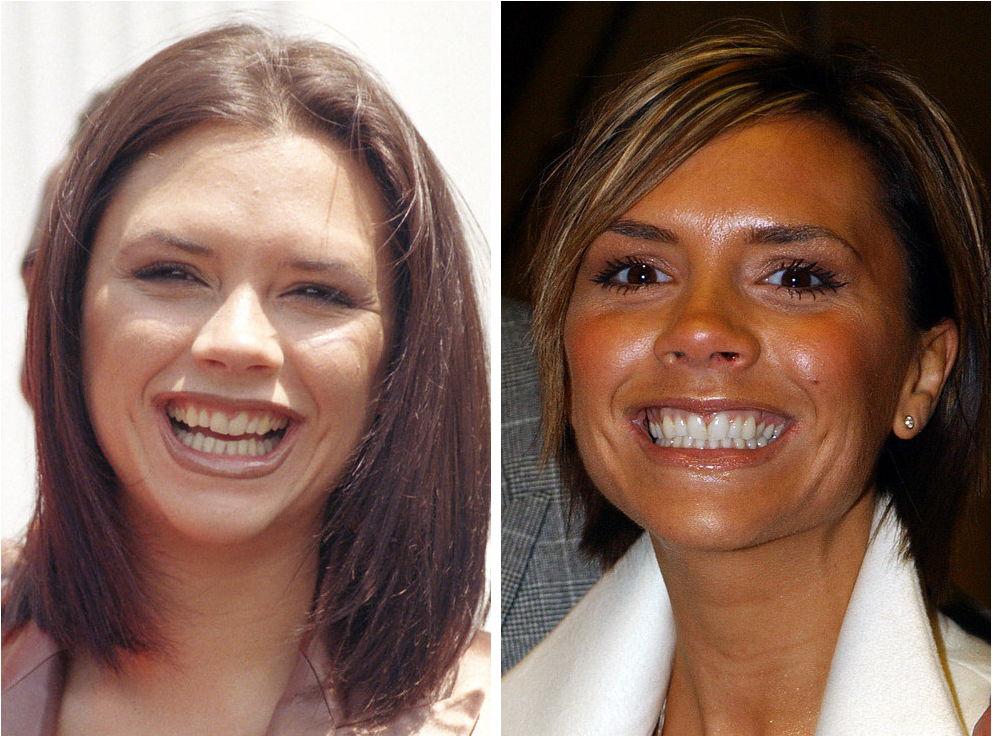 33 примера того как хорошие зубы изменили лицо!